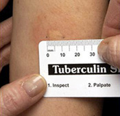 Tuberculin Skin Test