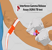 IGRA-TEST